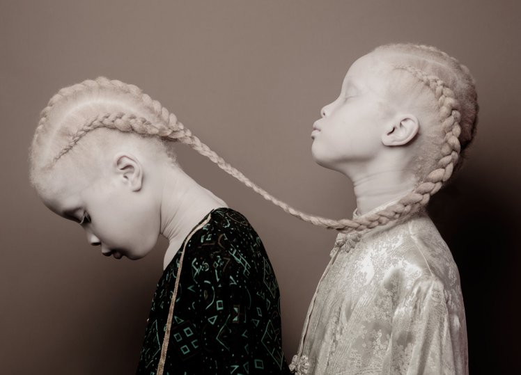 Twins with albinism become model